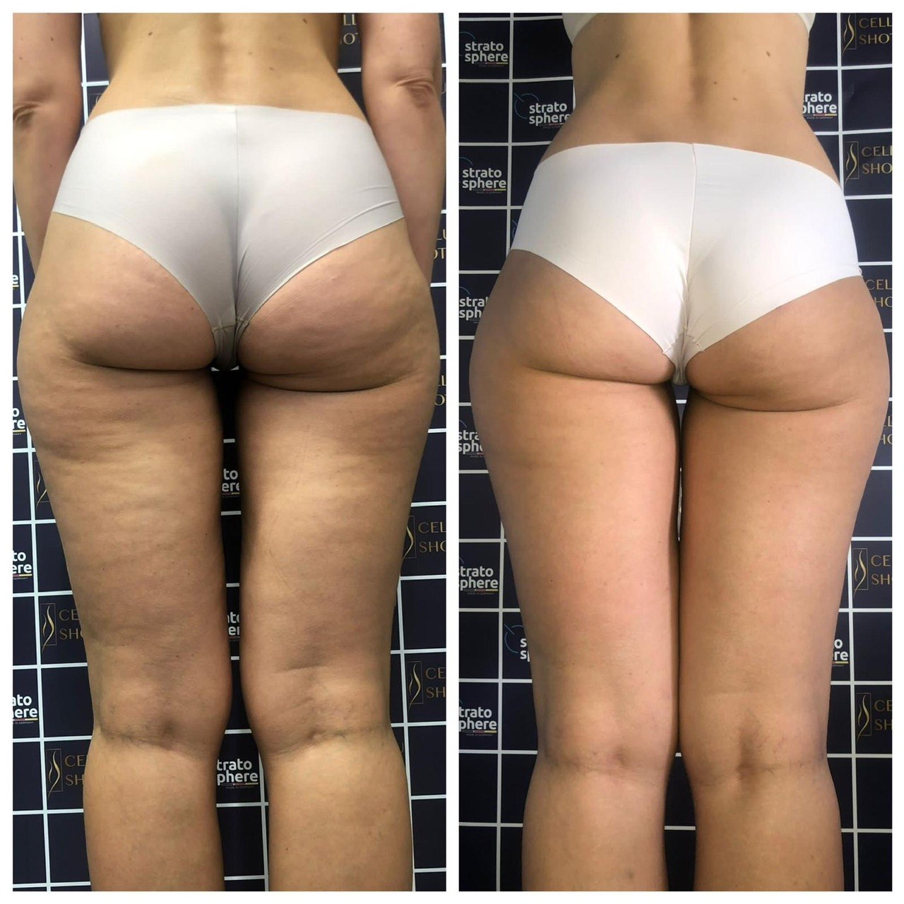 Stratosphere body contouring — ID Clinic Esbjerg