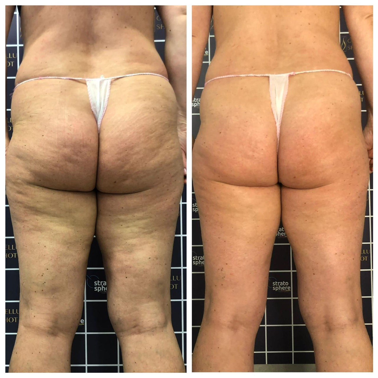 Stratosphere body contouring — ID Clinic Esbjerg