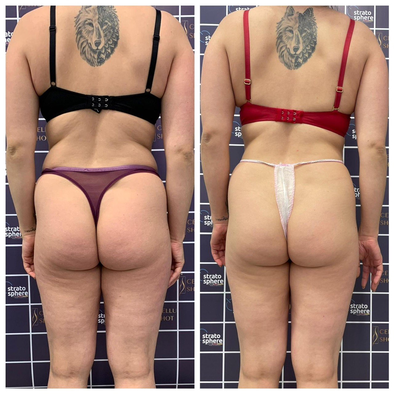 Stratosphere body contouring — ID Clinic Esbjerg