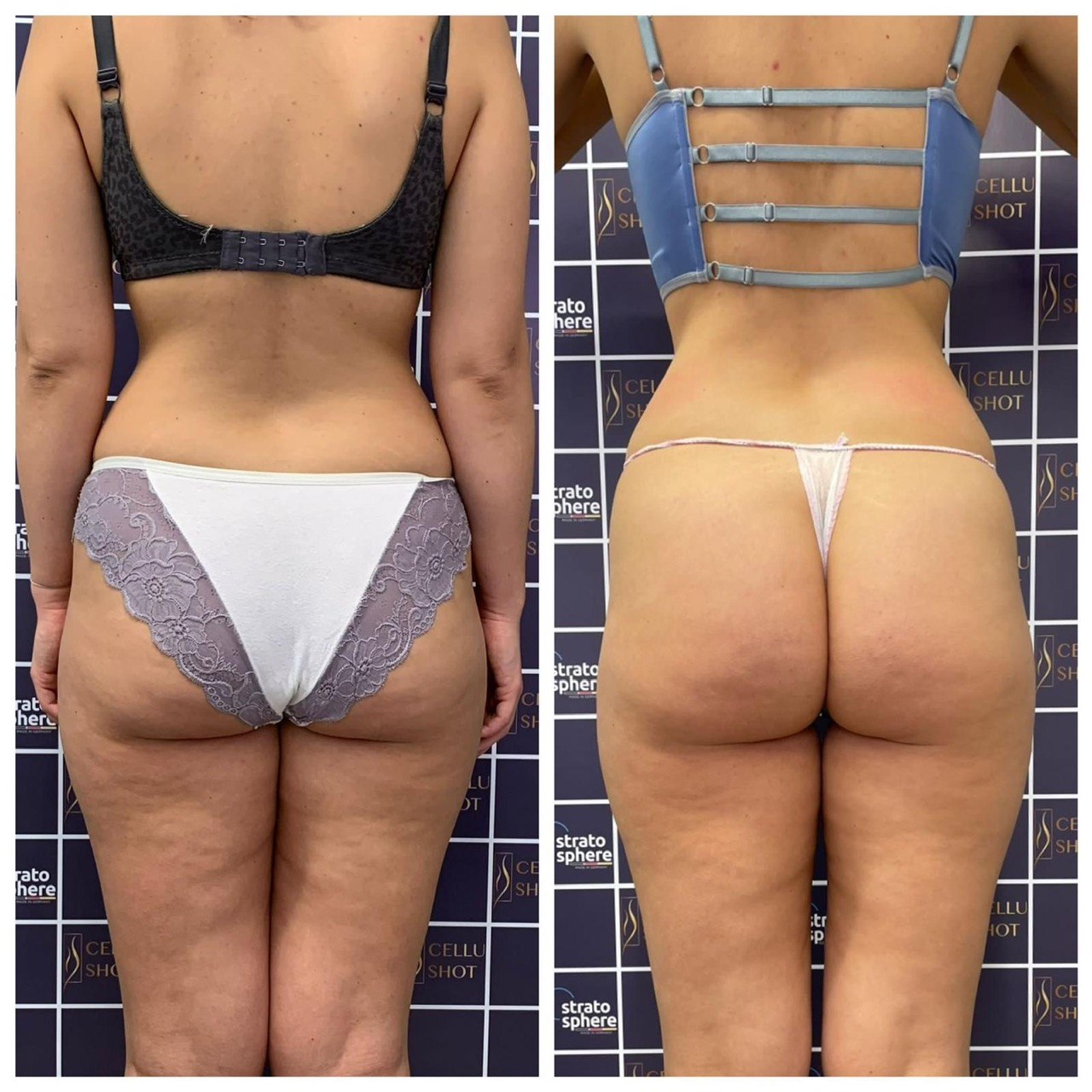 Stratosphere body contouring — ID Clinic Esbjerg