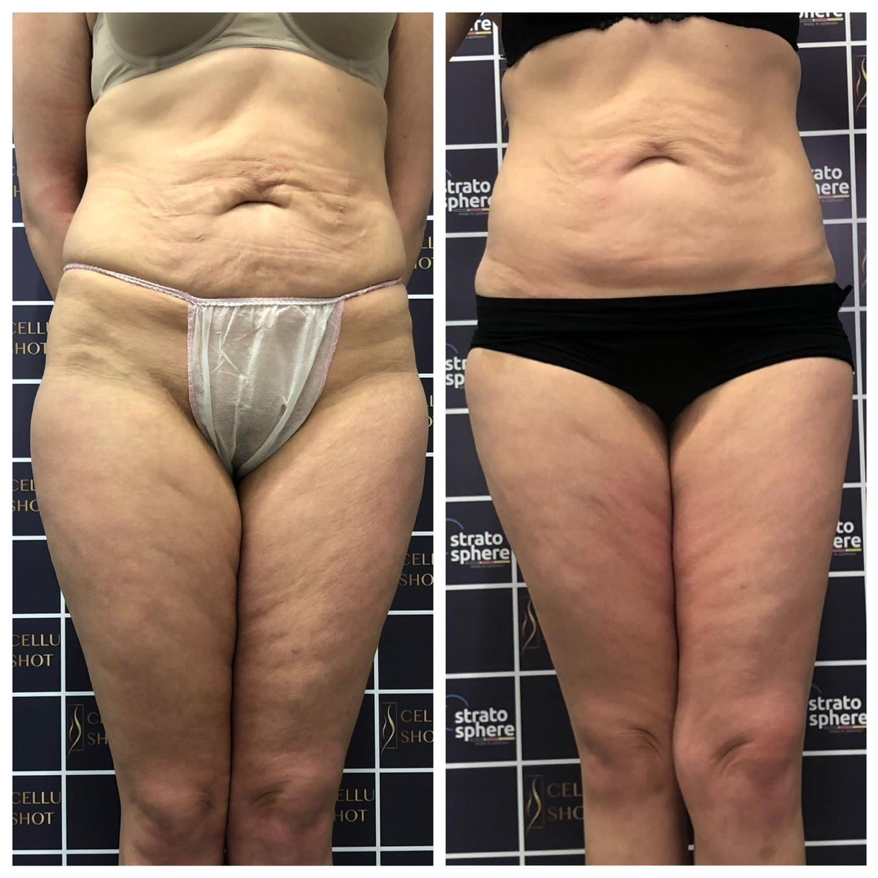 Stratosphere body contouring — ID Clinic Esbjerg