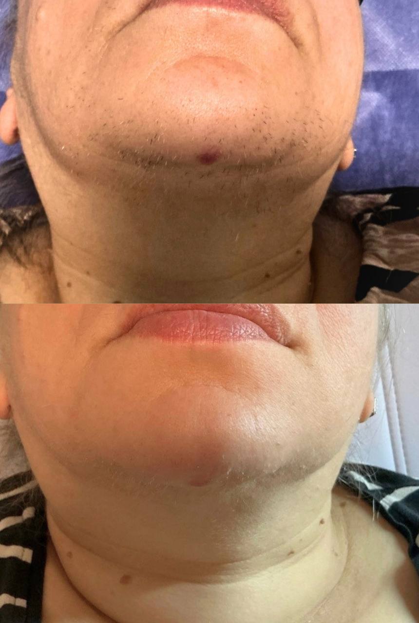 Behandlingsresultat 11